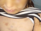 Волгоградцы требуют лишить родительских прав отца жестоко избитой мачехой восьмилетней девочки