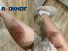 Бездомные собаки изувечили ноги молодой женщине на юге Волгограда