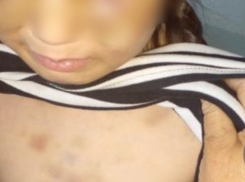 Волгоградцы требуют лишить родительских прав отца жестоко избитой мачехой восьмилетней девочки