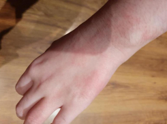 Высыпания и зуд появляются на теле 11-летней волгоградки после купания в желтой воде