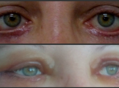 Волжанка стала жертвой пластической хирургии: 1,5 года женщина не могла открыть глаза