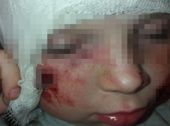 Бродячая собака разорвала лицо 7-летней девочке в Волгоградской области