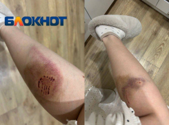 Бездомные собаки изувечили ноги молодой женщине на юге Волгограда