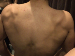 Прыщавая спина спортсмена из Волгограда вызвала бурю насмешек