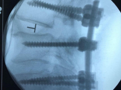 Волгоградские врачи спасли мужчину после 5 неудачных операций в США