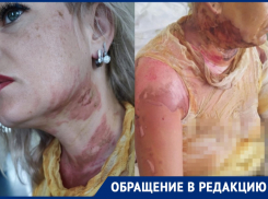 Москвичку с подругой поджег шашлычник на турбазе в Волгограде 
