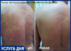 Лечение псориаза  по специальной цене