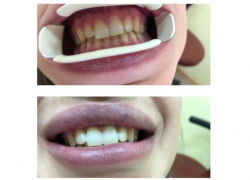 Волгоградский врач-стоматолог развеял популярные мифы об имплантации зубов