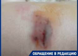 «Пришлось своими силами лечиться»: как в травмпунктах 7-летней волгоградке отказались оказать помощь