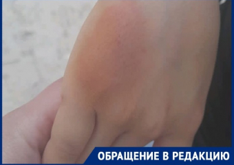 10-летнюю волгоградку укусил питон 