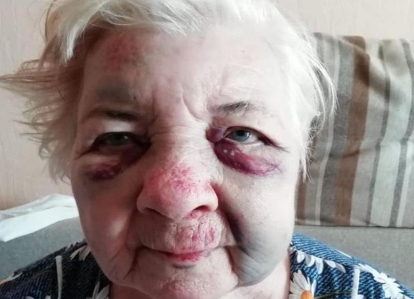 84-летнюю избитую волгоградку в 4 утра выставили из областной больницы домой