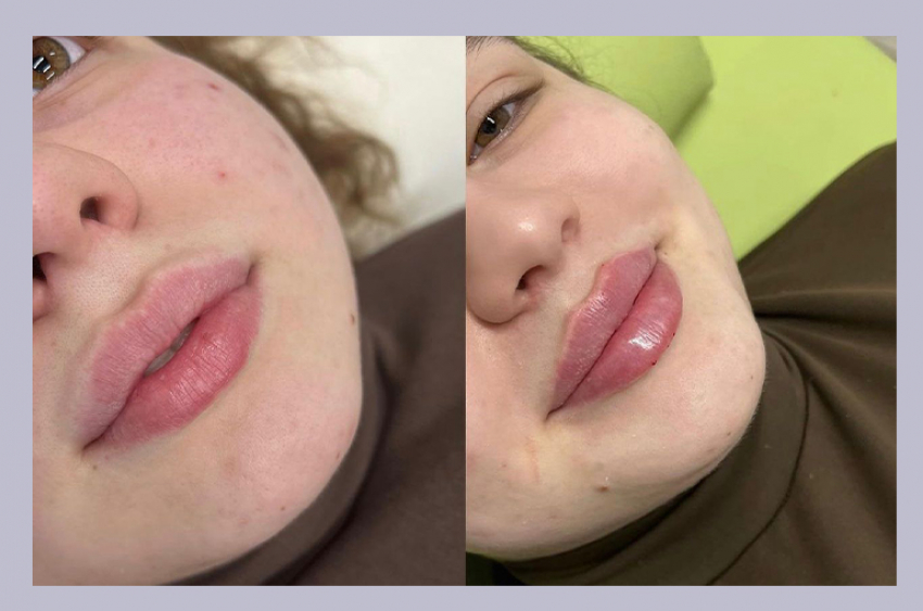 Увеличение, коррекция губ. Услуги косметолога. Заходи в справочник