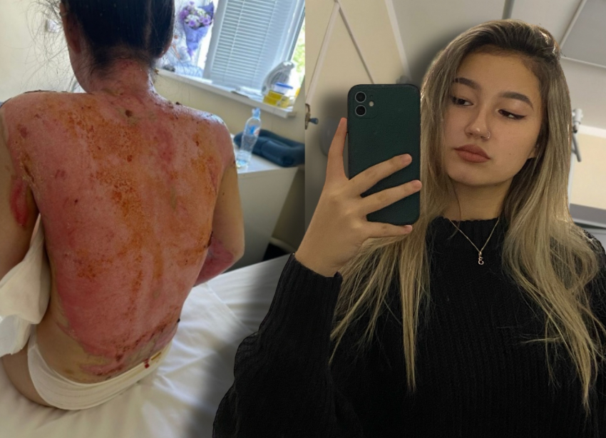 Откровенный рассказ 21-летней красавицы из Волгограда с жуткими ожогами: на девушку рухнул бойлер с кипятком