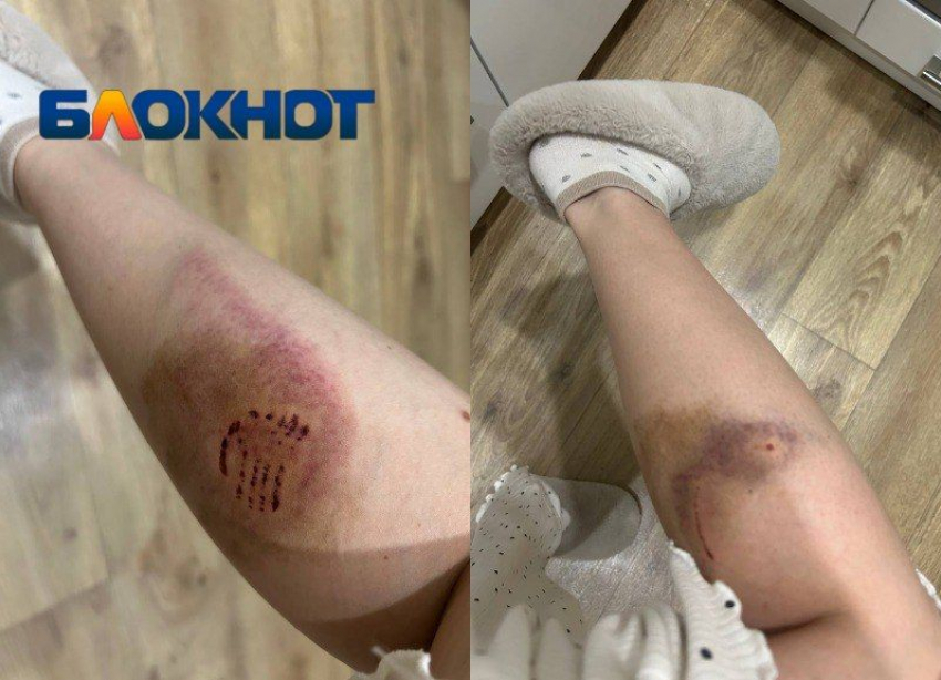 Бездомные собаки изувечили ноги молодой женщине на юге Волгограда