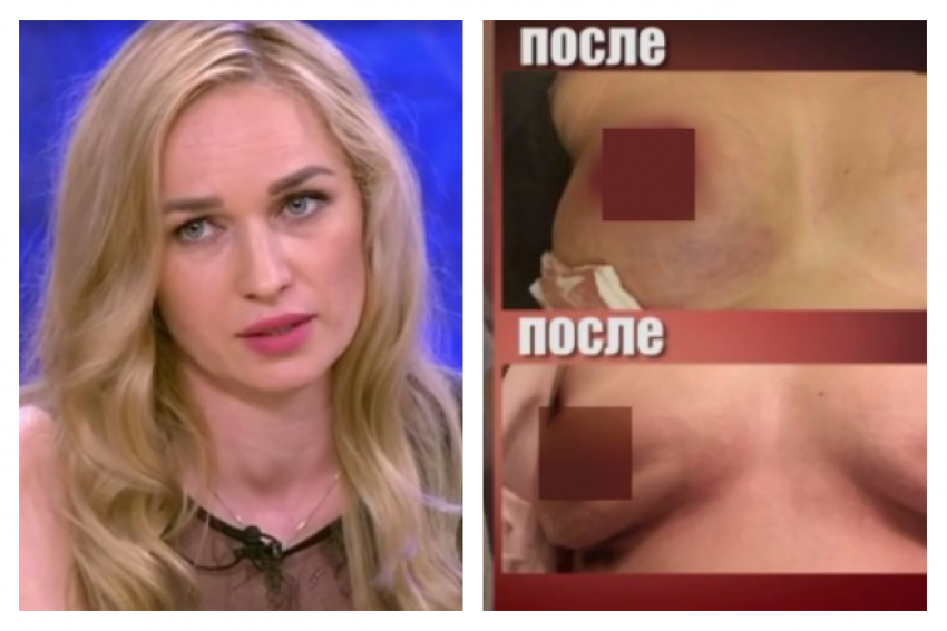 «Звездный» пластический хирург изуродовал грудь многодетной матери из Волгограда