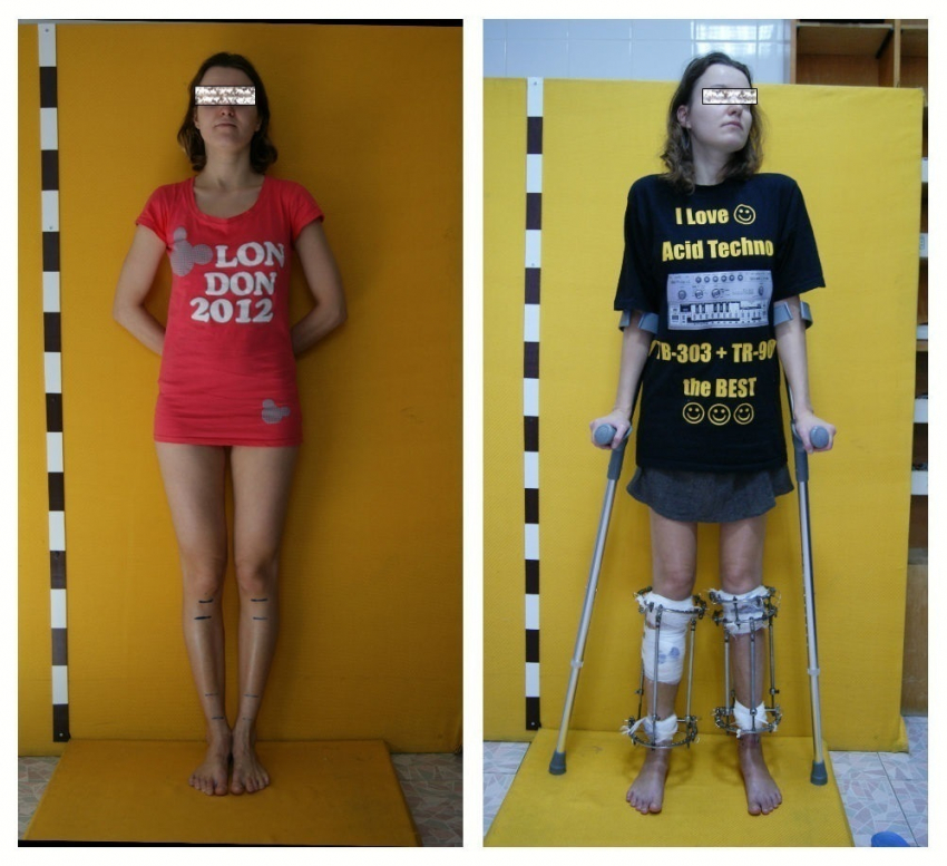  Девушка увеличивает ноги в Волгограде на 18 сантиметров 